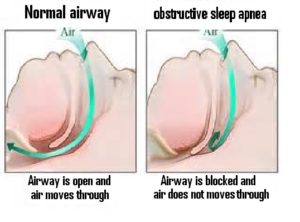 snoring causes and obstructive sleep apnea