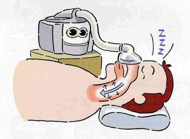 pap to treat snoring as antisnoring